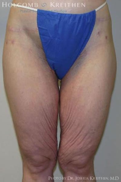 Thigh Lift Before & After Gallery - Patient 6236538 - Image 1