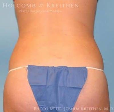 Liposuction Before & After Gallery - Patient 6236537 - Image 6