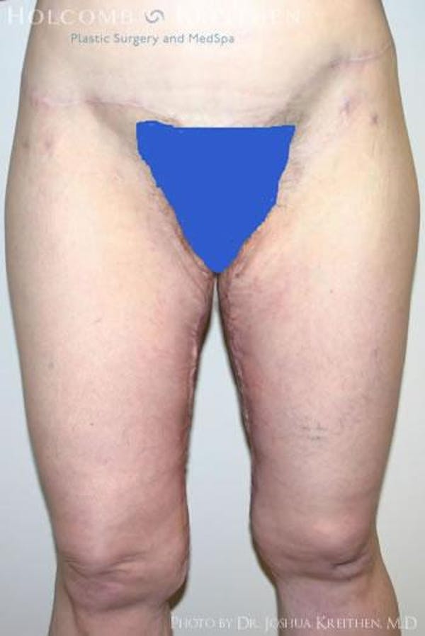 Thigh Lift Before & After Gallery - Patient 6236538 - Image 2