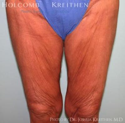Thigh Lift Before & After Gallery - Patient 6236540 - Image 1