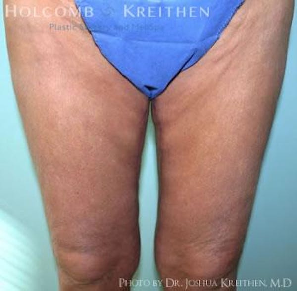 Thigh Lift Before & After Gallery - Patient 6236540 - Image 2