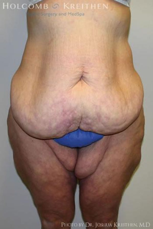 Thigh Lift Before & After Gallery - Patient 6236541 - Image 1