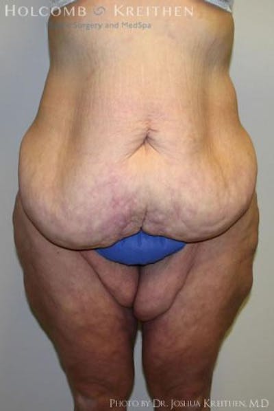 Thigh Lift Before & After Gallery - Patient 6236541 - Image 1