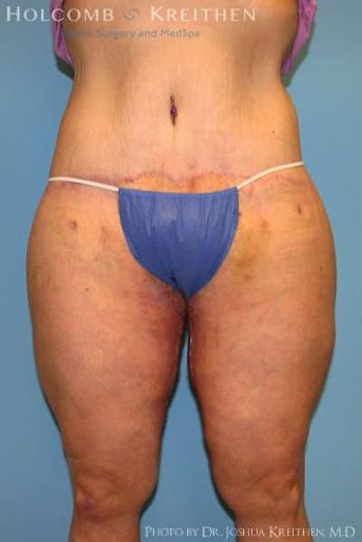 Thigh Lift Before & After Gallery - Patient 6236541 - Image 2