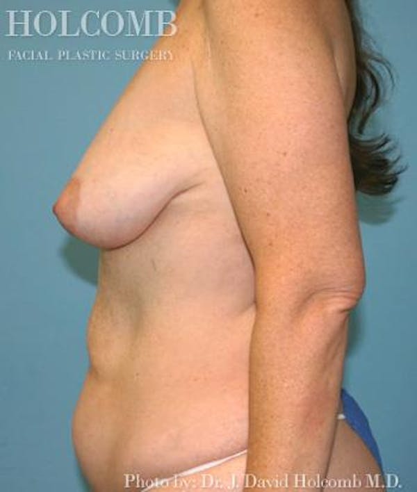 Mommy Makeover Before & After Gallery - Patient 6236542 - Image 5
