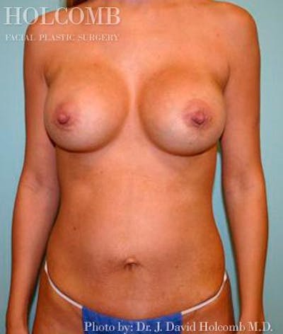 Mommy Makeover Before & After Gallery - Patient 6236546 - Image 2