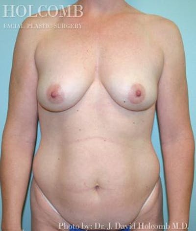 Mommy Makeover Gallery - Patient 6236548 - Image 1