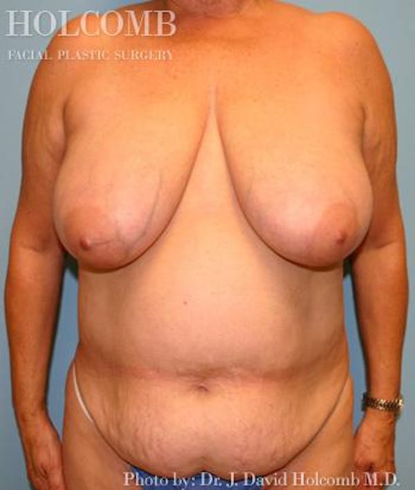 Mommy Makeover Before & After Gallery - Patient 6236553 - Image 1