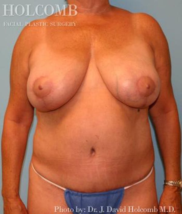 Mommy Makeover Before & After Gallery - Patient 6236553 - Image 2