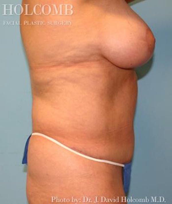 Mommy Makeover Gallery - Patient 6236553 - Image 4