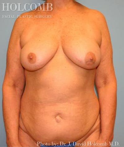 Mommy Makeover Before & After Gallery - Patient 6236554 - Image 1