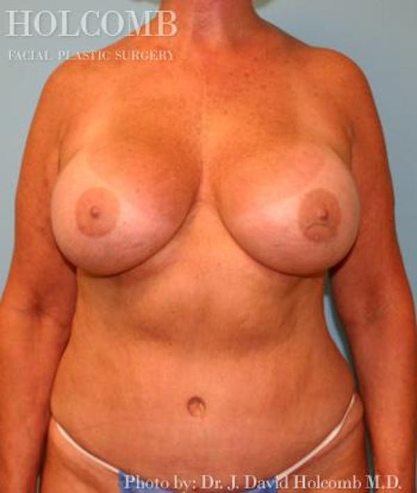 Mommy Makeover Before & After Gallery - Patient 6236554 - Image 2