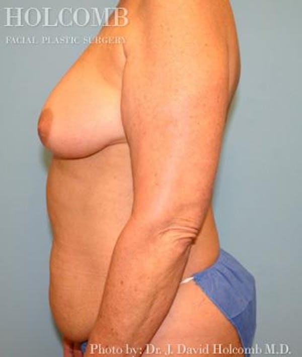 Mommy Makeover Before & After Gallery - Patient 6236554 - Image 5
