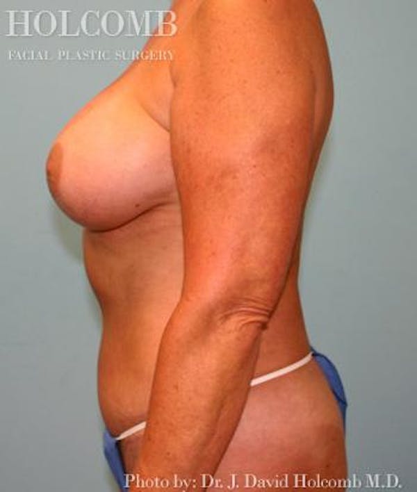 Mommy Makeover Before & After Gallery - Patient 6236554 - Image 6