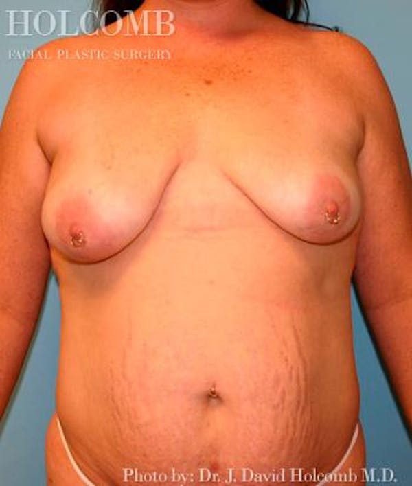 Mommy Makeover Before & After Gallery - Patient 6236556 - Image 1