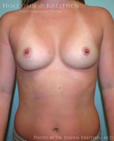 Breast Augmentation Before & After Gallery - Patient 6236557 - Image 1