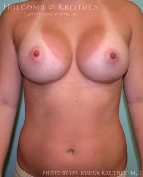 Breast Augmentation Before & After Gallery - Patient 6236557 - Image 2
