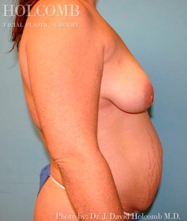 Mommy Makeover Gallery - Patient 6236556 - Image 5
