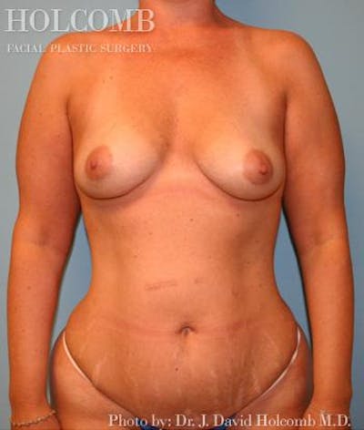 Mommy Makeover Gallery - Patient 6236559 - Image 1
