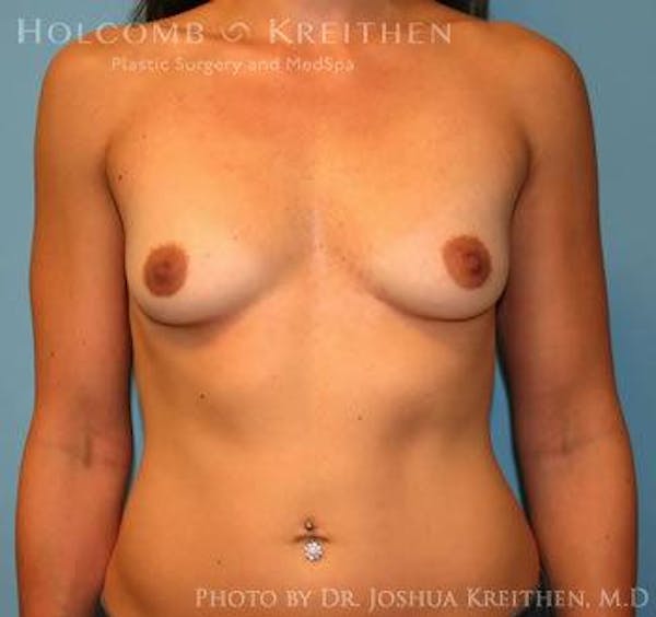 Breast Augmentation Before & After Gallery - Patient 6236558 - Image 1