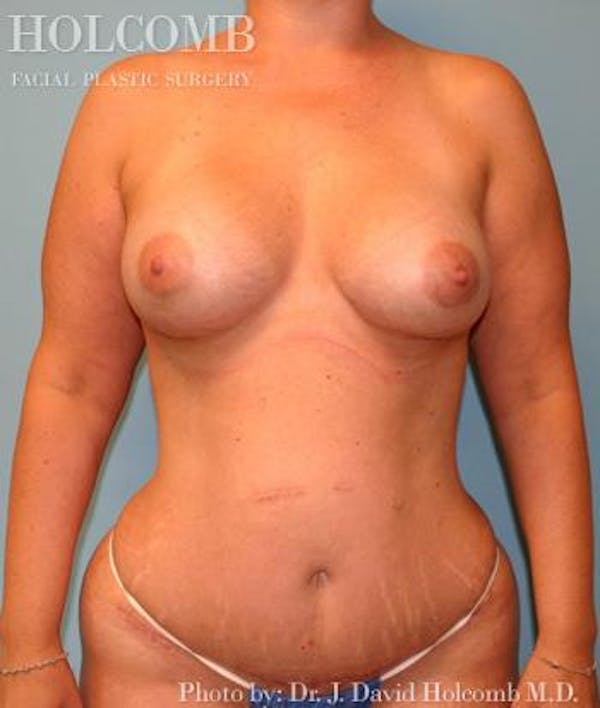 Mommy Makeover Before & After Gallery - Patient 6236559 - Image 2