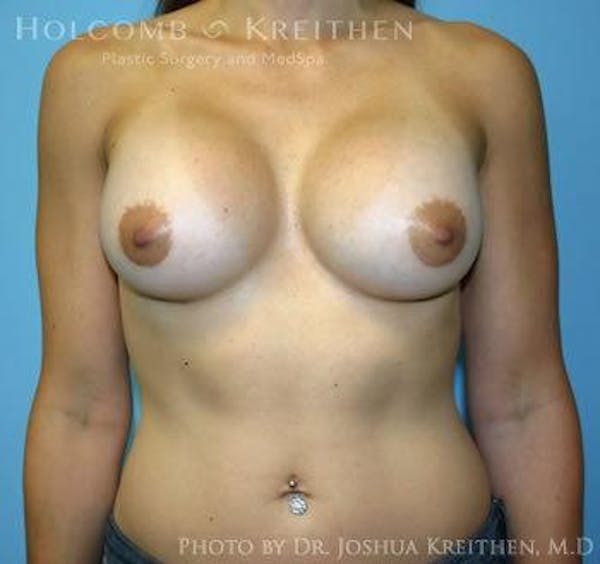 Breast Augmentation Before & After Gallery - Patient 6236558 - Image 2