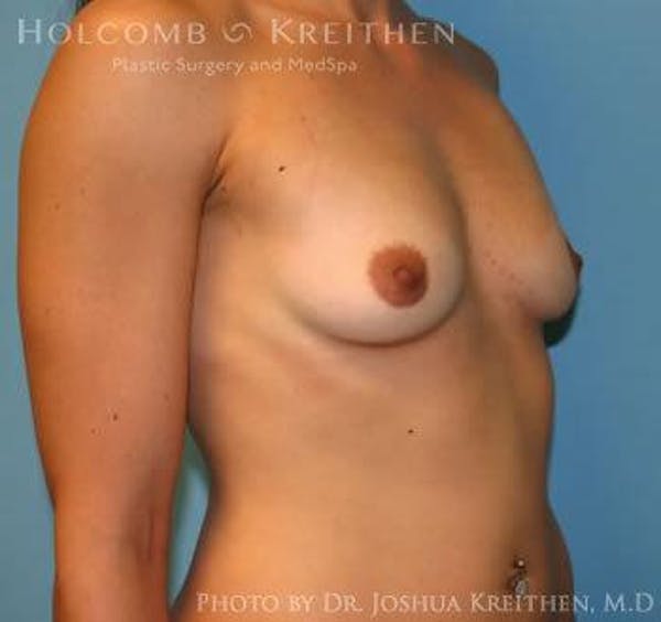 Breast Augmentation Before & After Gallery - Patient 6236558 - Image 3