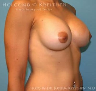 Breast Augmentation Before & After Gallery - Patient 6236558 - Image 4