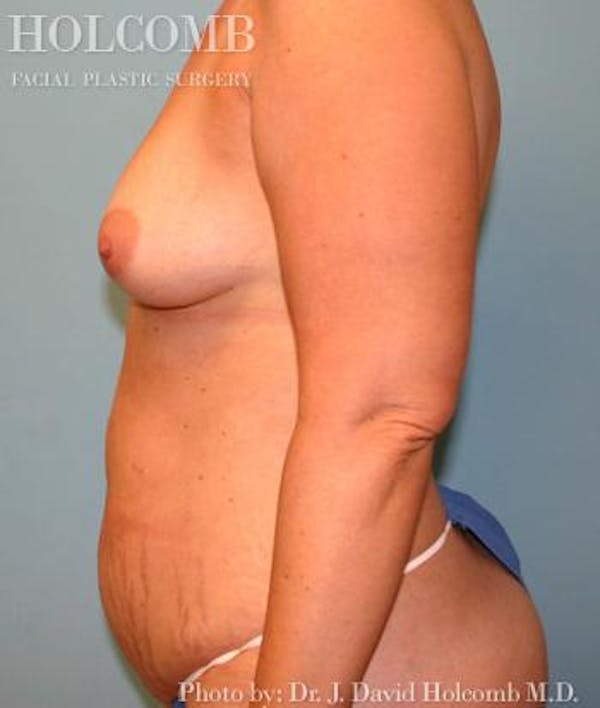 Mommy Makeover Before & After Gallery - Patient 6236559 - Image 5