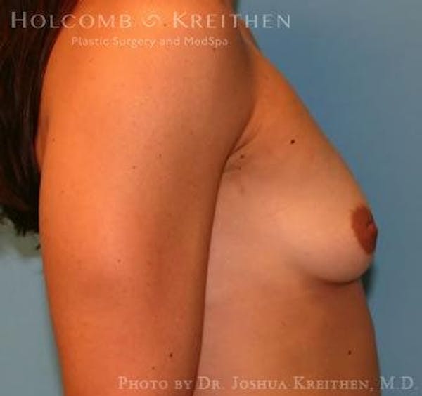Breast Augmentation Gallery - Patient 6236558 - Image 5