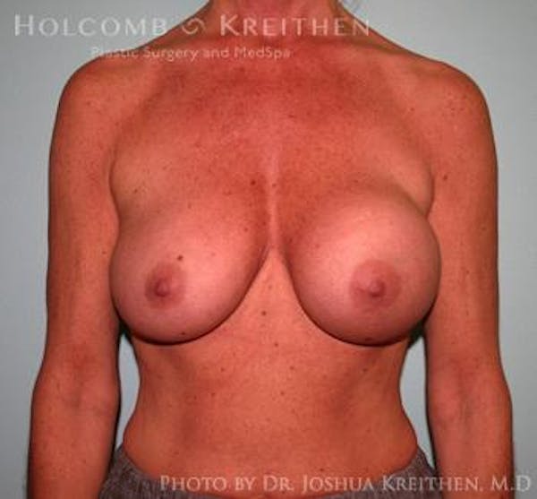 Breast Augmentation Gallery - Patient 6236560 - Image 1