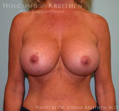 Breast Augmentation Gallery - Patient 6236560 - Image 2