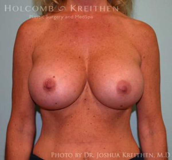 Breast Augmentation Before & After Gallery - Patient 6236560 - Image 2