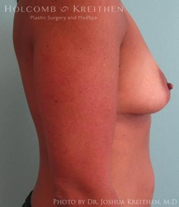 Breast Augmentation Before & After Gallery - Patient 6236562 - Image 5