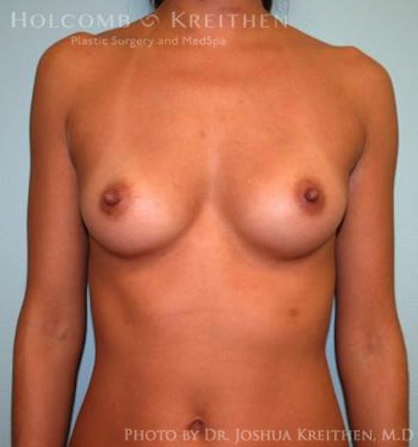 Breast Augmentation Before & After Gallery - Patient 6236563 - Image 1