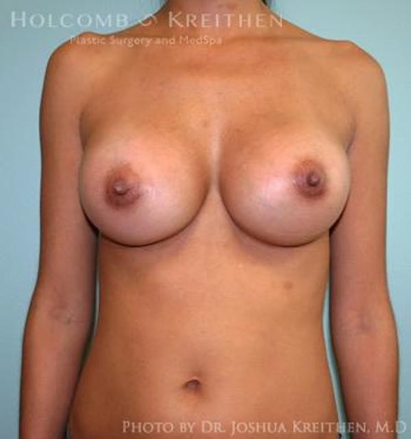 Breast Augmentation Gallery - Patient 6236563 - Image 2
