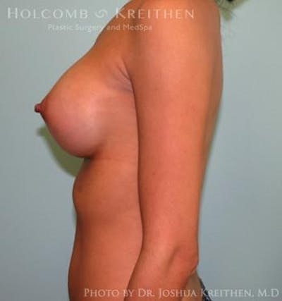 Breast Augmentation Before & After Gallery - Patient 6236563 - Image 6