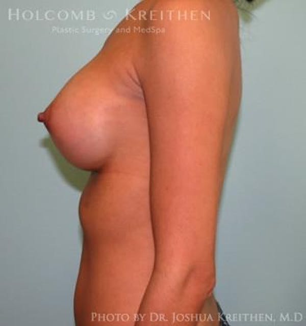 Breast Augmentation Gallery - Patient 6236563 - Image 6