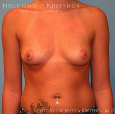 Breast Augmentation Before & After Gallery - Patient 6236564 - Image 1