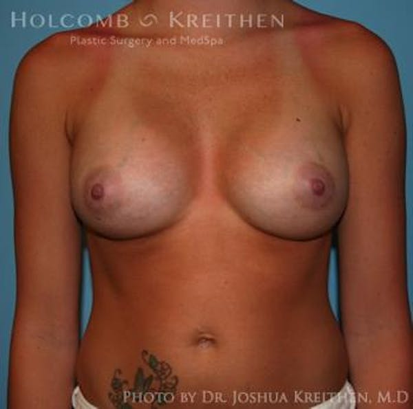 Breast Augmentation Gallery - Patient 6236564 - Image 2