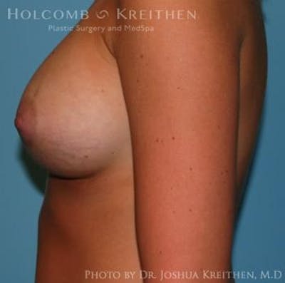 Breast Augmentation Gallery - Patient 6236564 - Image 6