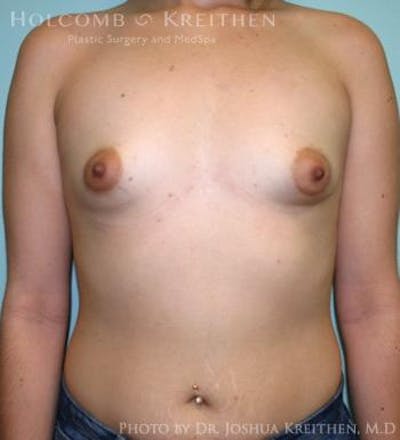 Breast Augmentation Before & After Gallery - Patient 6236565 - Image 1