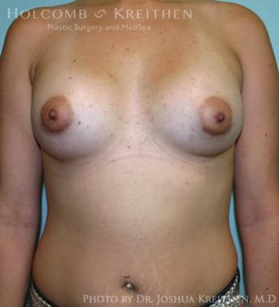 Breast Augmentation Before & After Gallery - Patient 6236565 - Image 2