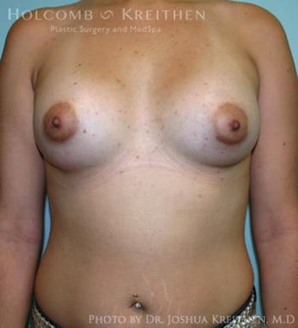 Breast Augmentation Before & After Gallery - Patient 6236565 - Image 2