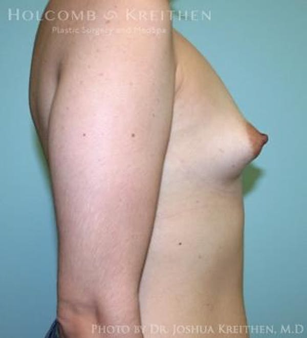Breast Augmentation Gallery - Patient 6236565 - Image 5