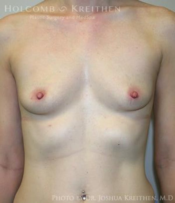 Breast Augmentation Gallery - Patient 6236567 - Image 1