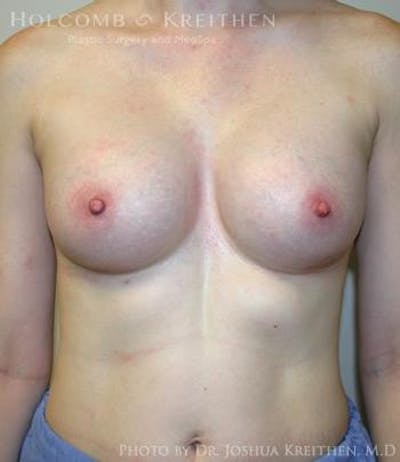 Breast Augmentation Before & After Gallery - Patient 6236567 - Image 2