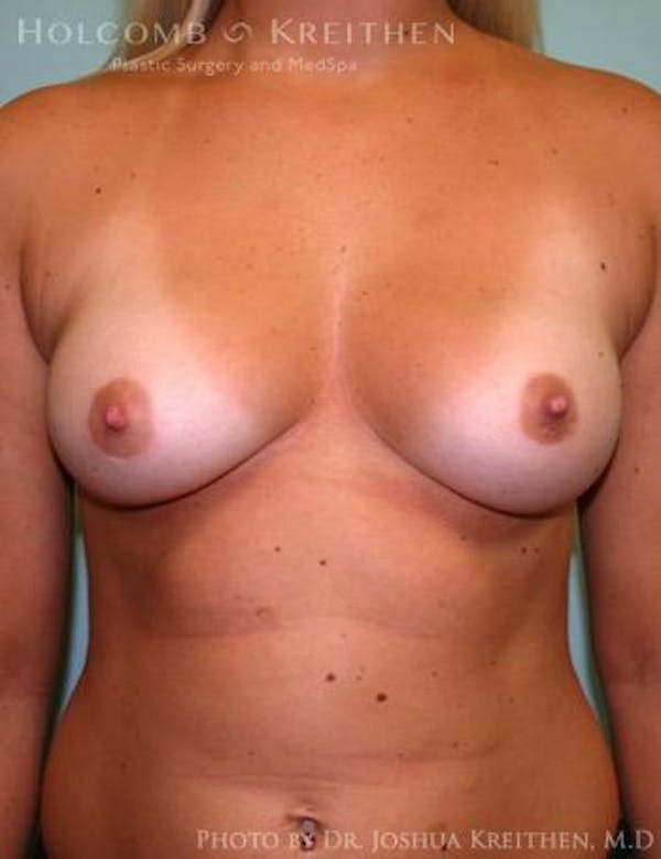 Breast Augmentation Before & After Gallery - Patient 6236568 - Image 1
