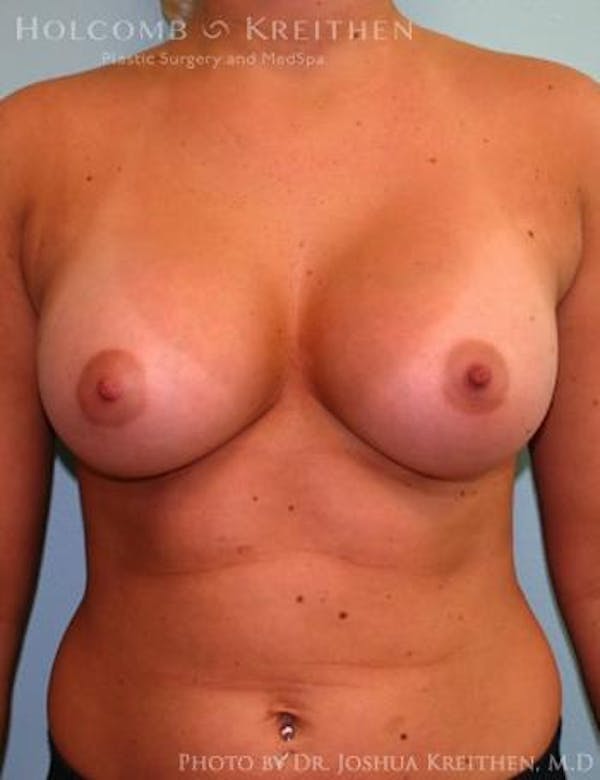 Breast Augmentation Before & After Gallery - Patient 6236568 - Image 2