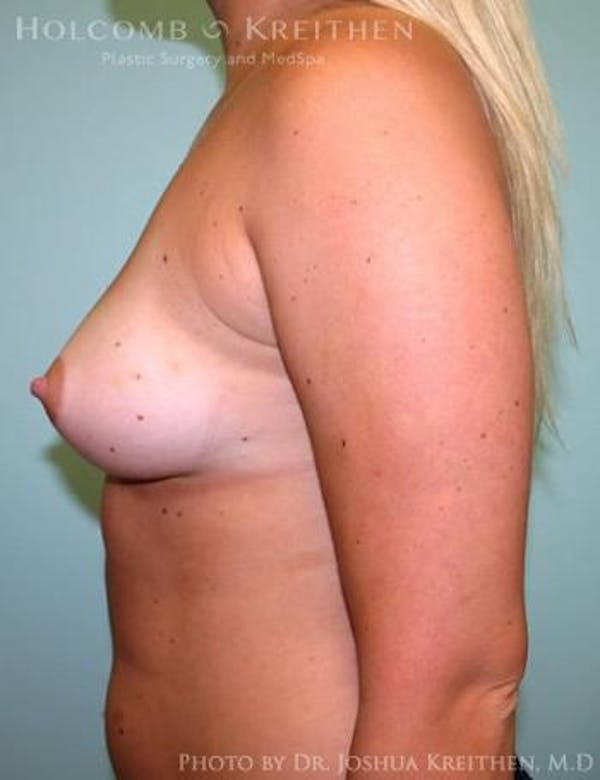 Breast Augmentation Before & After Gallery - Patient 6236568 - Image 5